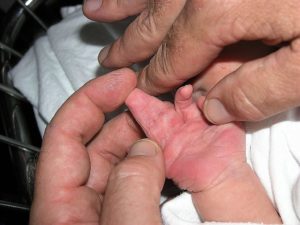 1024px-New_born_boy_showing_complete_complex_syndactyly_with_two_fingers_right_hand