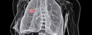 Übergewicht & Lungenkrebs: Lungenkarzinome bei Adipositas