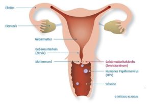 Übergewicht und Gebärmutter(hals)krebs - Zervixkarzinome