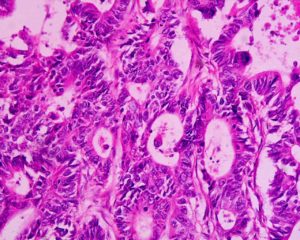 Brustkrebs Früherkennung: Biopsien, Tumormarker und Molekulargenetik