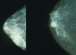 Übergewicht und Brustkrebs: Risiken von Brustkarzinomen bei Adipositas