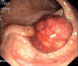 Polyp